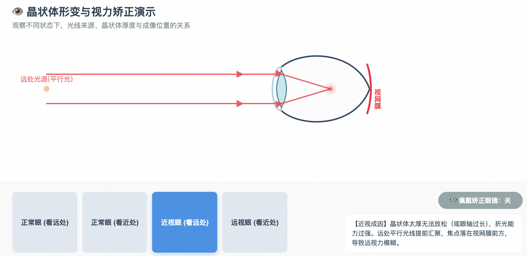 近视眼与远视眼成因及矫正原理